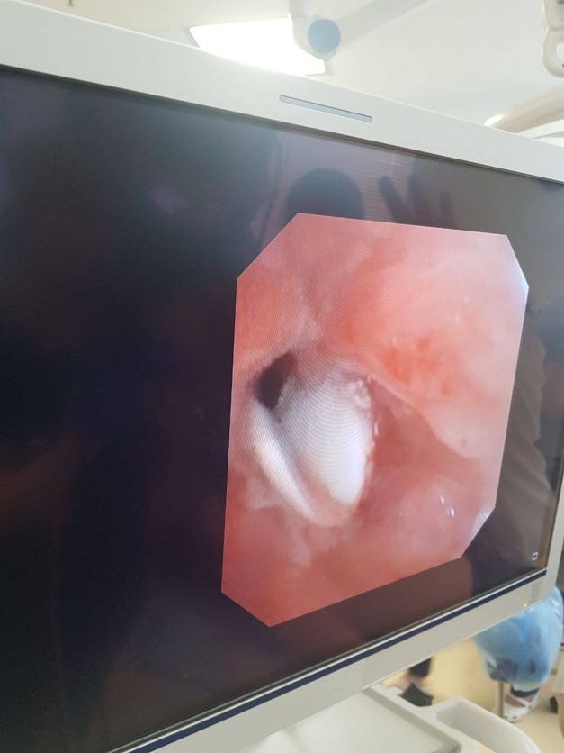 У Києві в дівчинки дістали 4-сантиметрову ложечку з дихальних шляхів 2