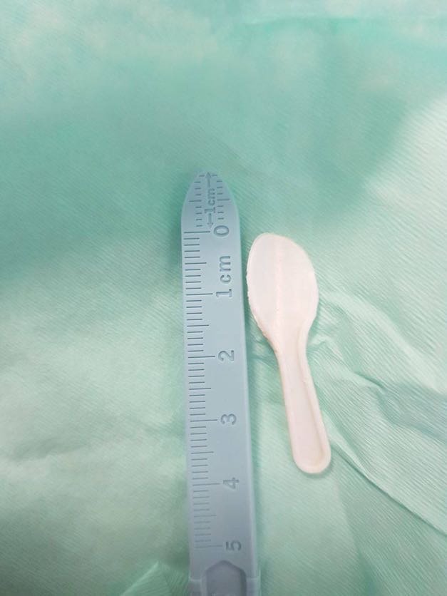 У Києві в дівчинки дістали 4-сантиметрову ложечку з дихальних шляхів 3