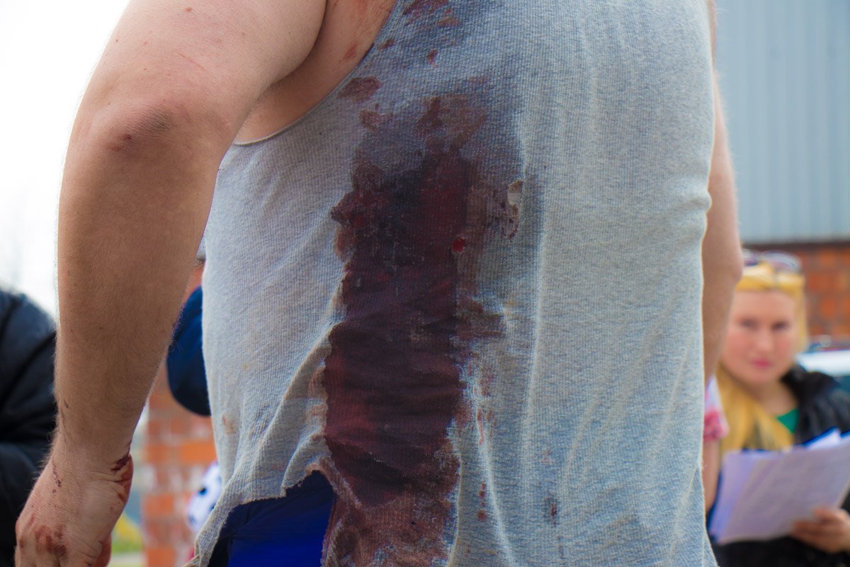 Пострадавший получил ранение в голову и спину