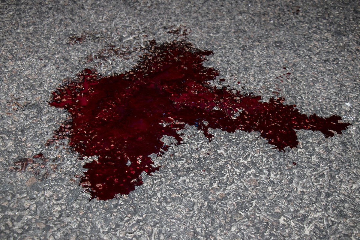 У потерпевшей травмы руки и ног, на месте где случилась авария лужа крови