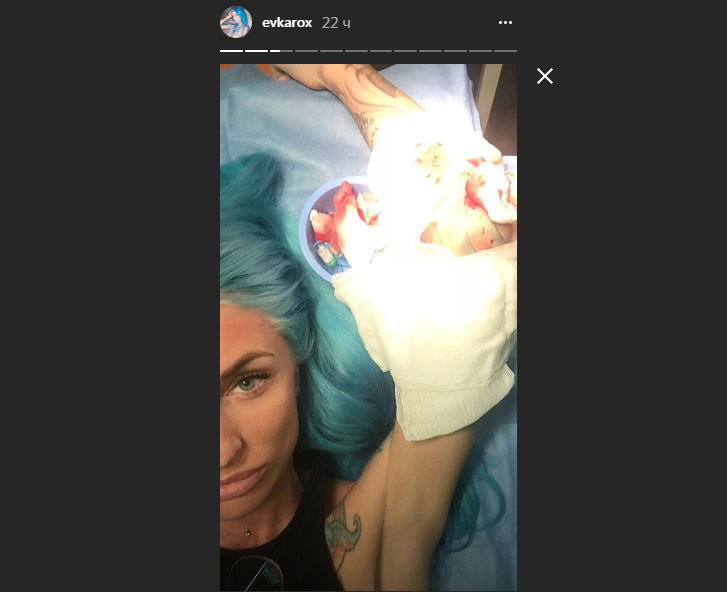 В результате аварии девушка получила травму руки