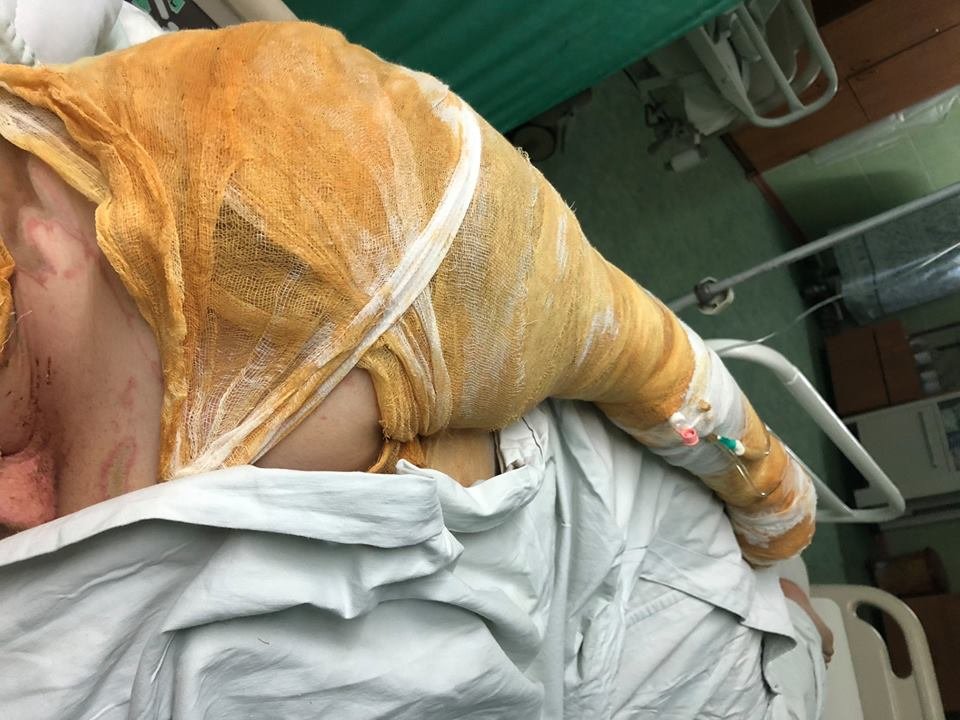 Нападавший выплеснул на Екатерину Гандзюк около 1 литра едкой жидкости