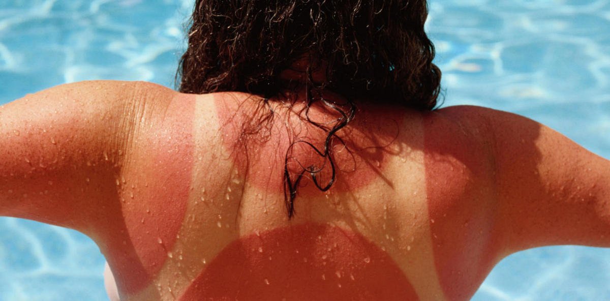 Мазать солнечные ожоги сметаной, маслом или зубной пастой – очень плохая идея Мазать солнечные ожоги сметаной, маслом или зубной пастой – очень плохая идея