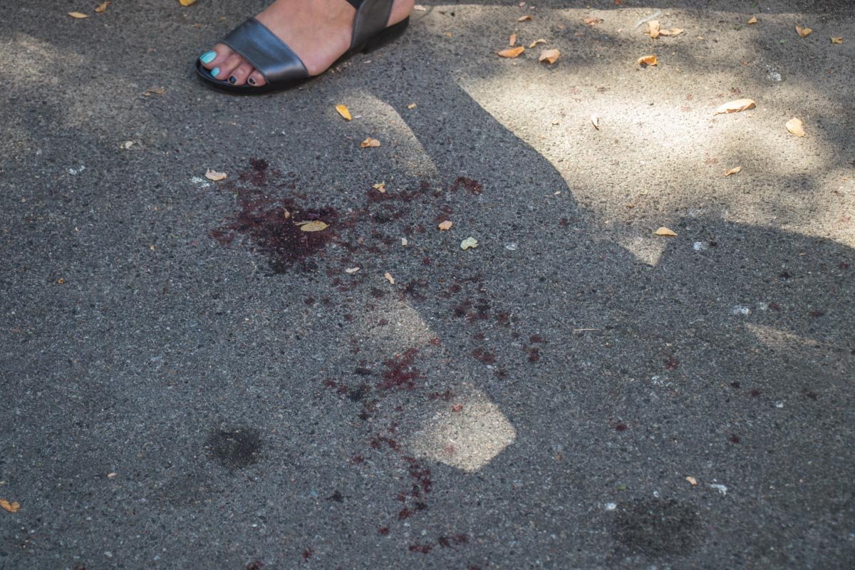 Ему оторвало кисть руки мусоровозом