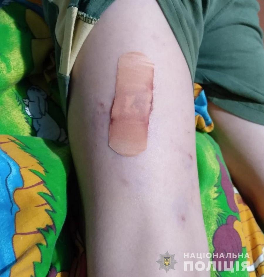 Бойцовские собаки покусали 9-летнего мальчика