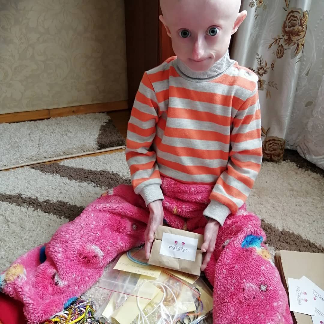 В Украине умерла 10-летняя девочка с редчайшим синдромом преждевременного старения 2