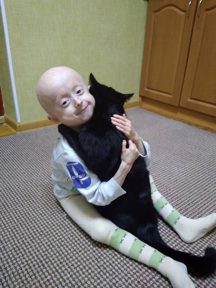 В Украине умерла 10-летняя девочка с редчайшим синдромом преждевременного старения 3