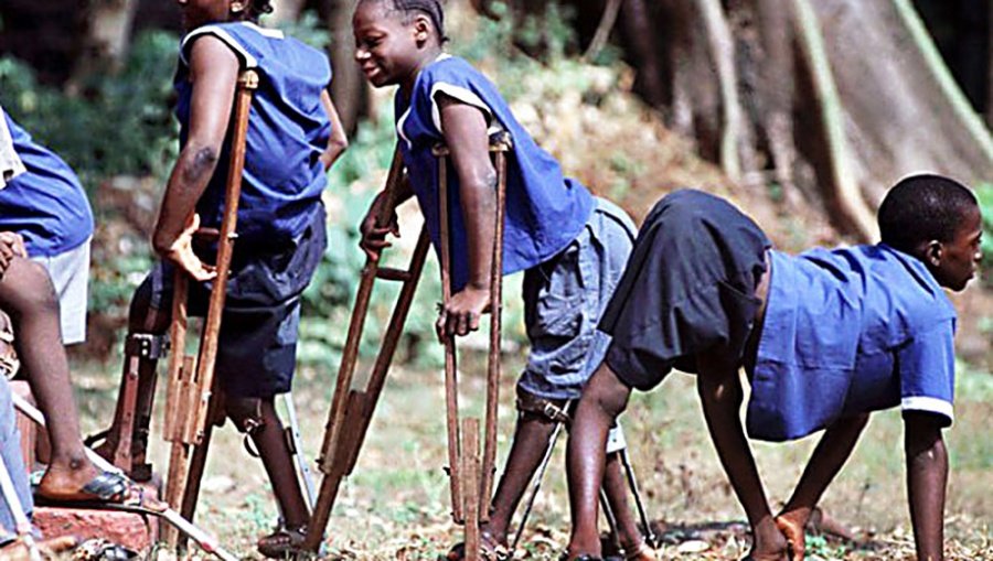 Последствия полиомиелита Последствия полиомиелита