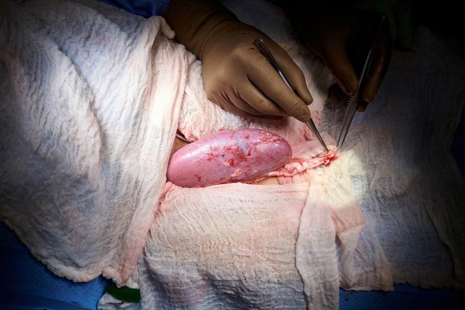 В США впервые пересадили почку от свиньи человеку 1