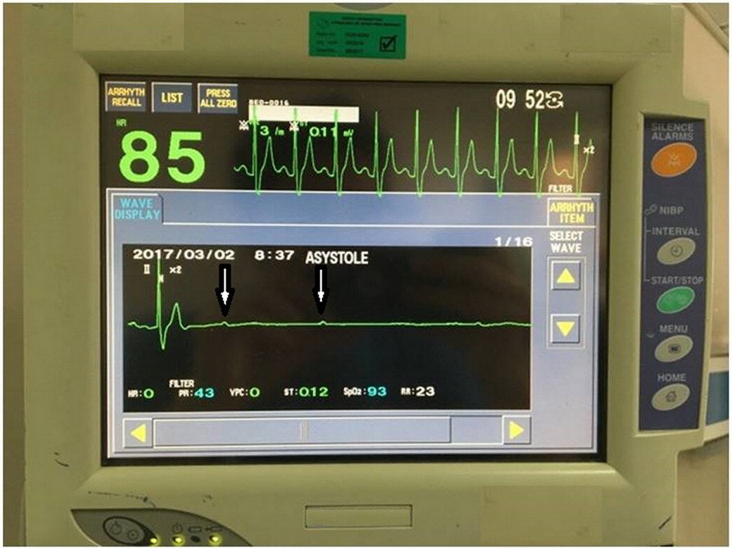 Остановка сердца Остановка сердца