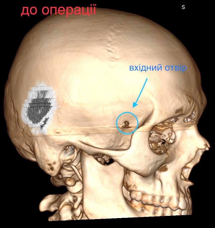 У Волинській області підліток випадково вистрілив собі в голову і вижив 1