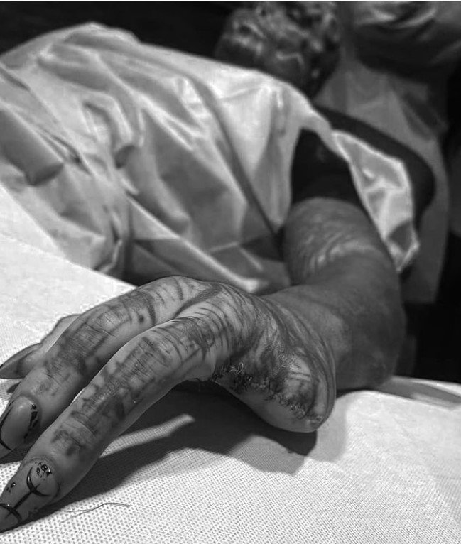 Француз відрізав собі пальці, щоб стати схожим на інопланетянина 1