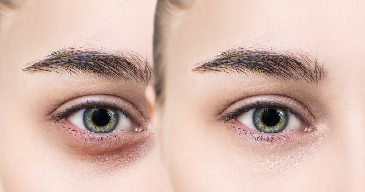 Як прибрати мішки під очима? 1