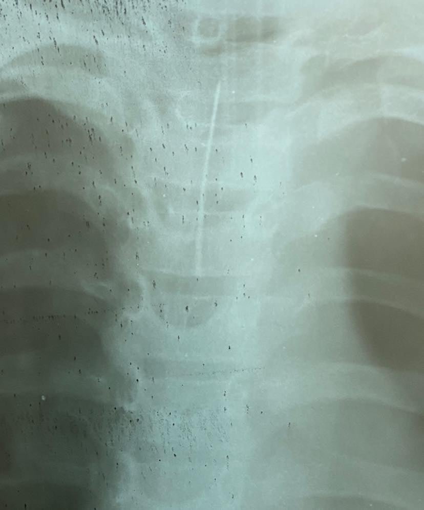 В Черкассах ребёнок проглотил иглу 1