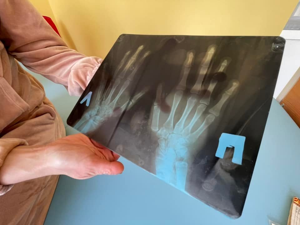 Во Львове врачи прооперировали девочку, которая родилась с шестью пальцами на руке 1