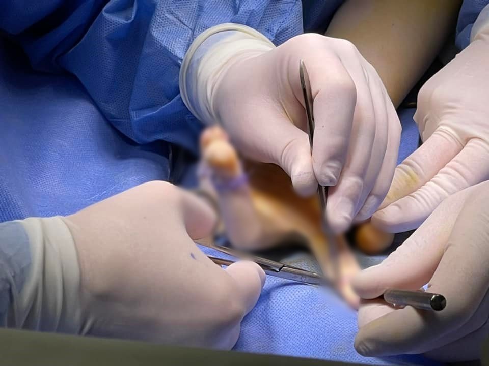 Во Львове врачи прооперировали девочку, которая родилась с шестью пальцами на руке 3