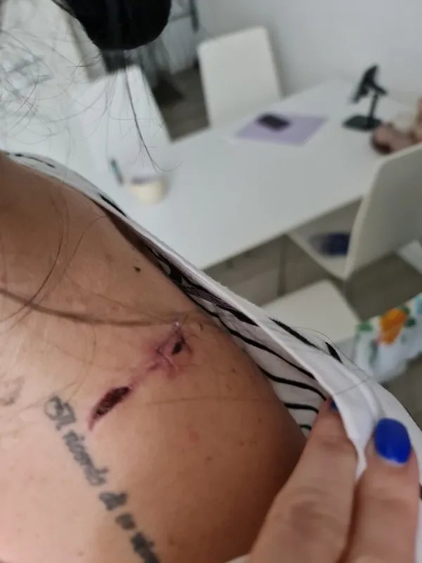 Під час удару Ірина отримала травму голови і численні уламкові ушкодження. Зашивали "наживу" - у лікарів не було знеболювального Під час удару Ірина отримала травму голови і численні уламкові ушкодження. Зашивали "наживу" - у лікарів не було знеболювального