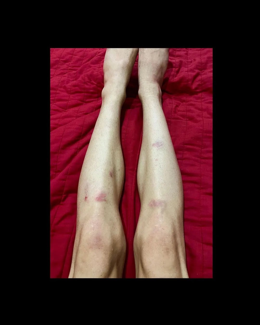 На тілі художника залишилося багато синців