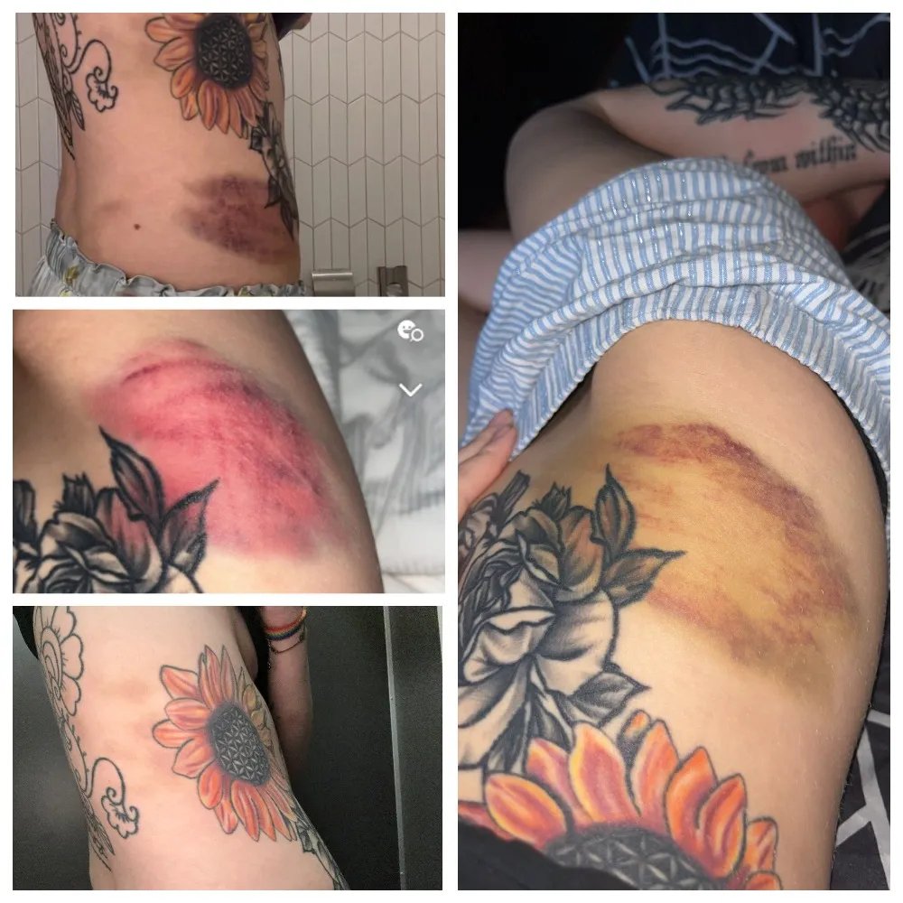 Синці на тілі Шелбі Лінн