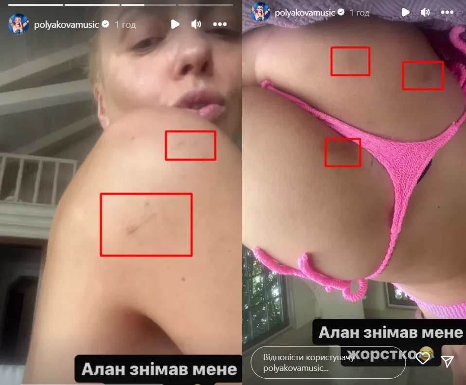 Синці на тілі Олі Полякової після зйомок нового кліпу
