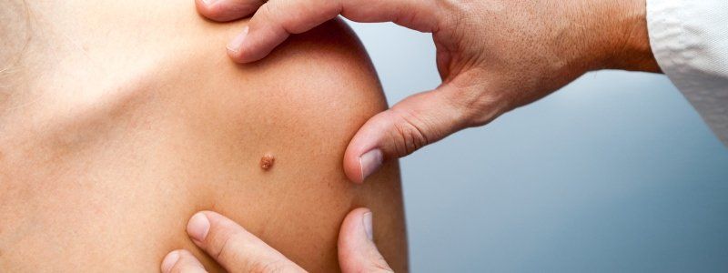 В каком случае и где удалять родинку