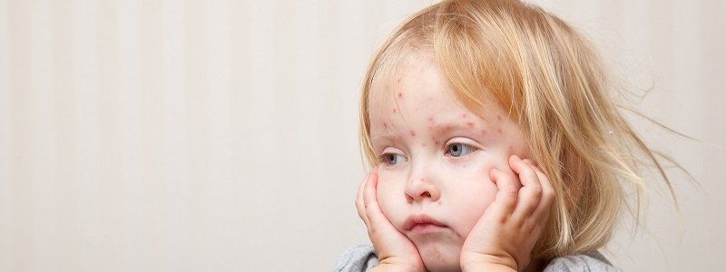 За июнь количество заболевших корью в Украине возросло в два раза: какая ситуация в Днепропетровской области и как с этим бороться