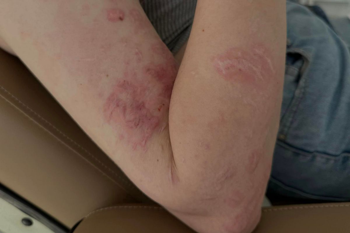 Нині на обличчі та тілі Анни все ще є рубці та шрами Нині на обличчі та тілі Анни все ще є рубці та шрами