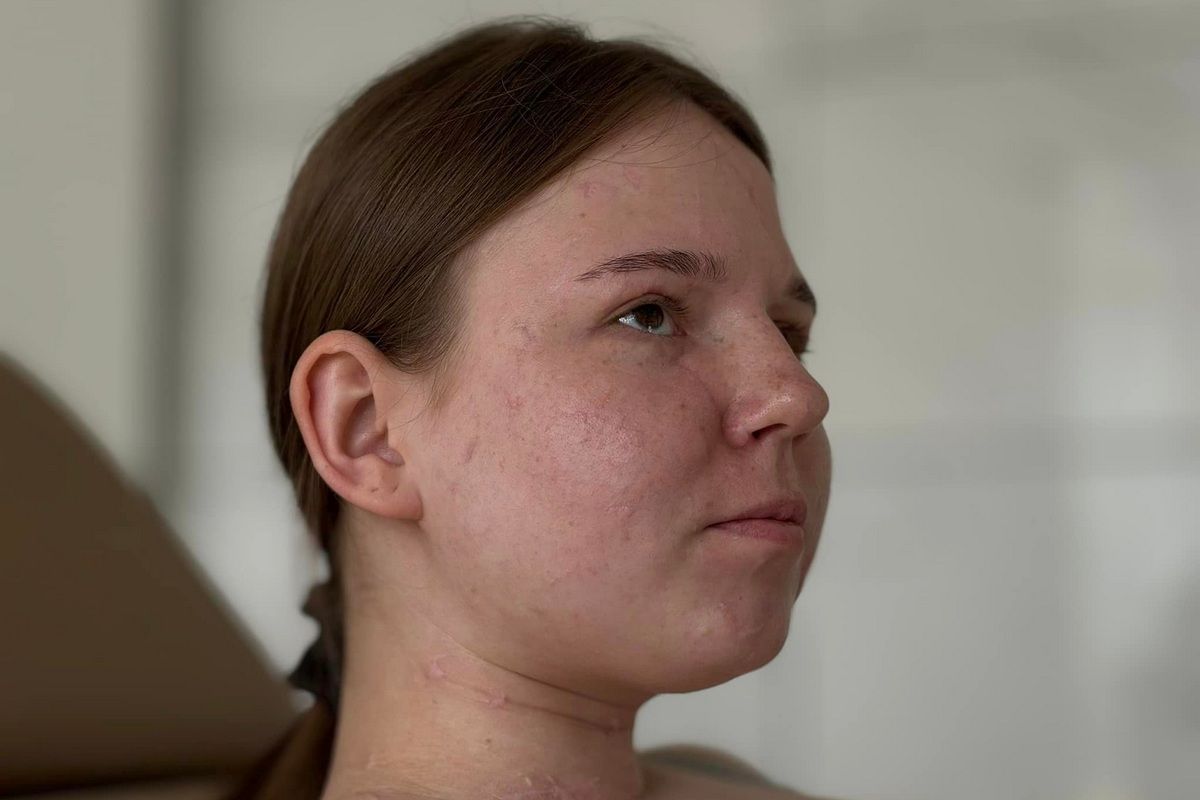 Уламки скла посікли обличчя та тіло дівчини Уламки скла посікли обличчя та тіло дівчини