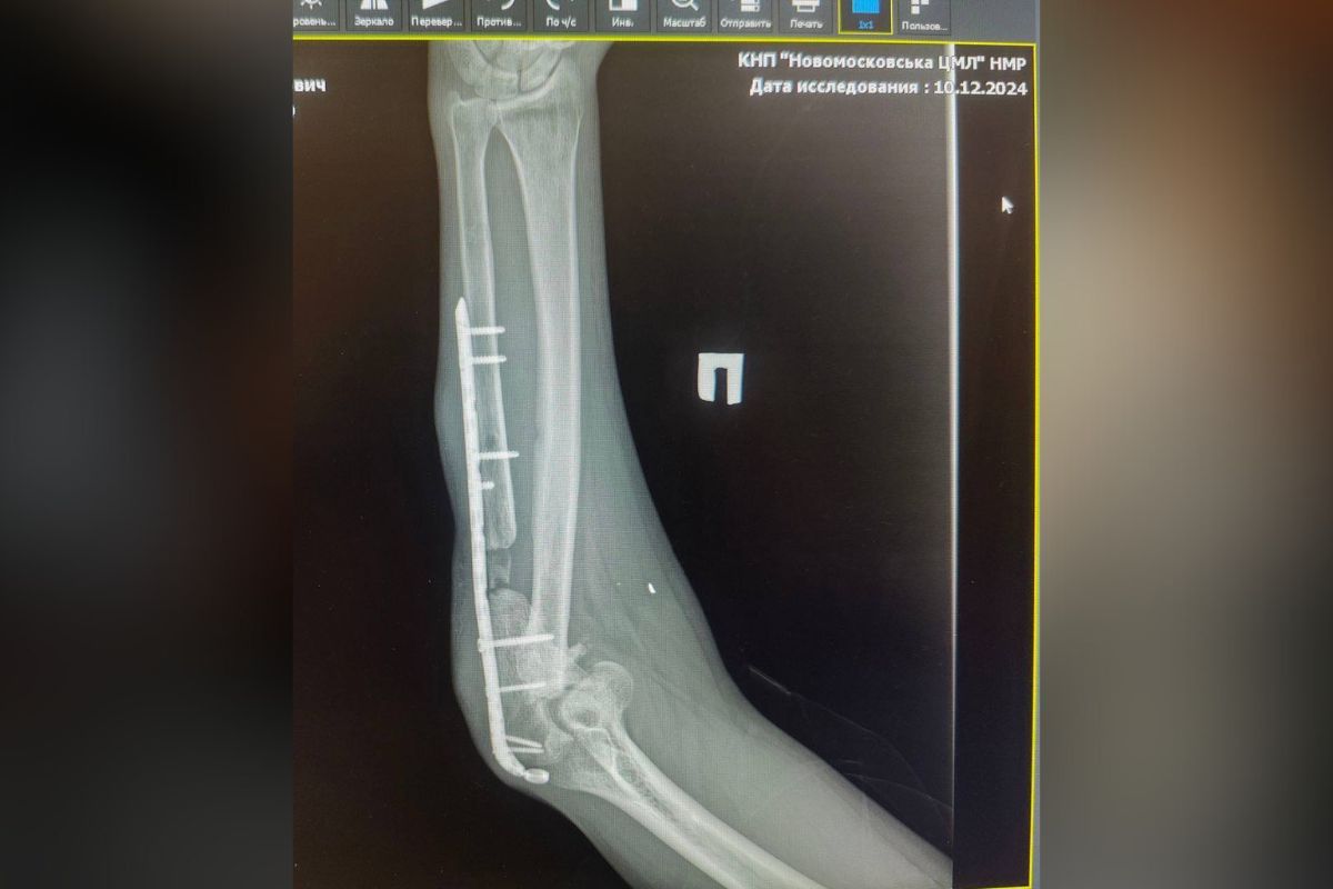 Рука бойца после ранения