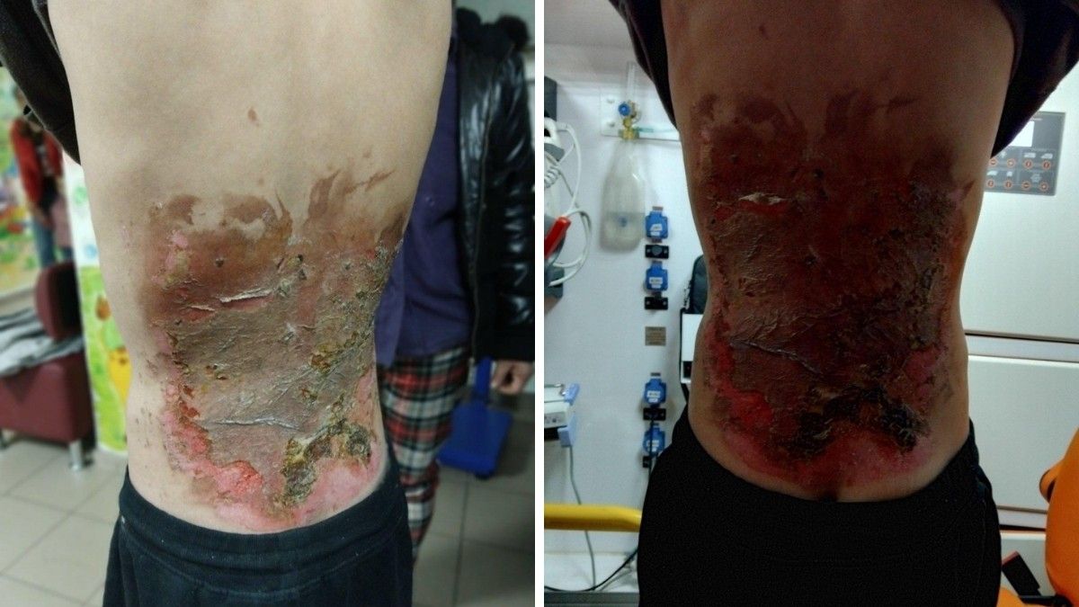 Ожоги подростка