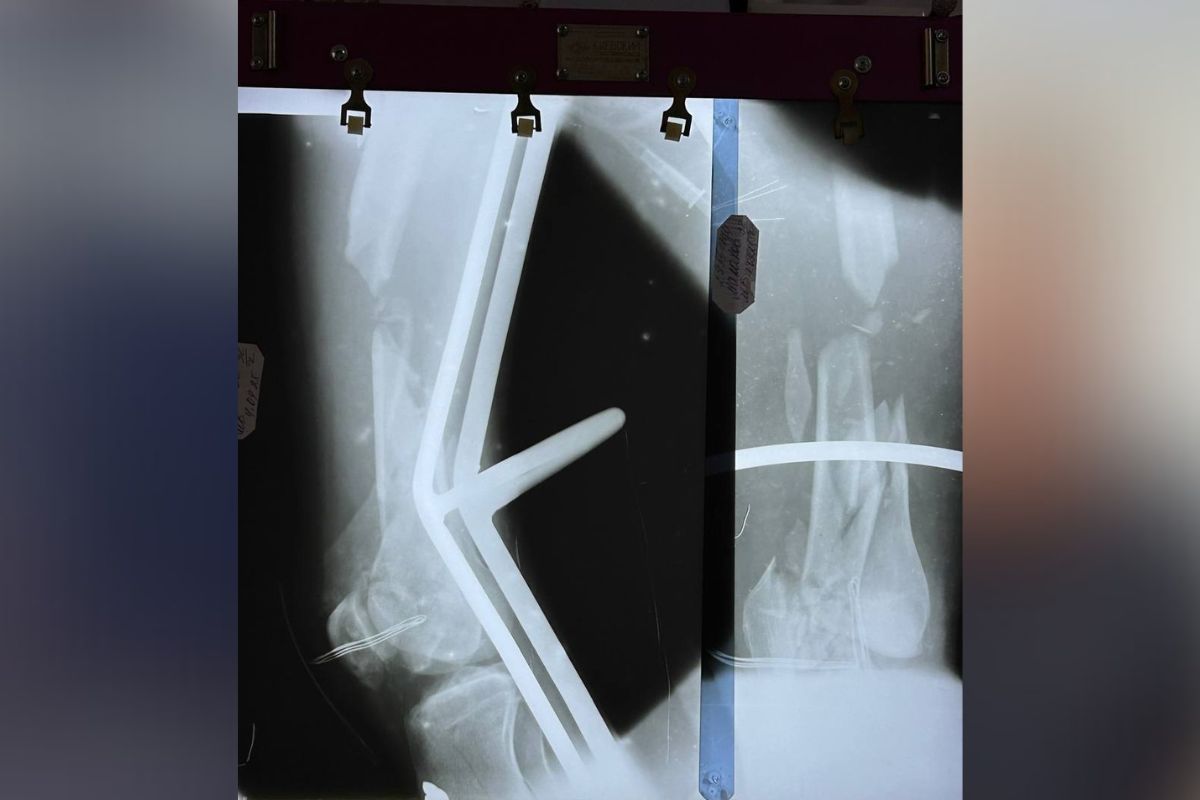 У ДТП мотоцикліст отримав важкі травми