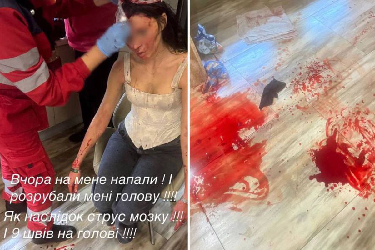 Жінка повідомила, що у неї діагностували струс мозку