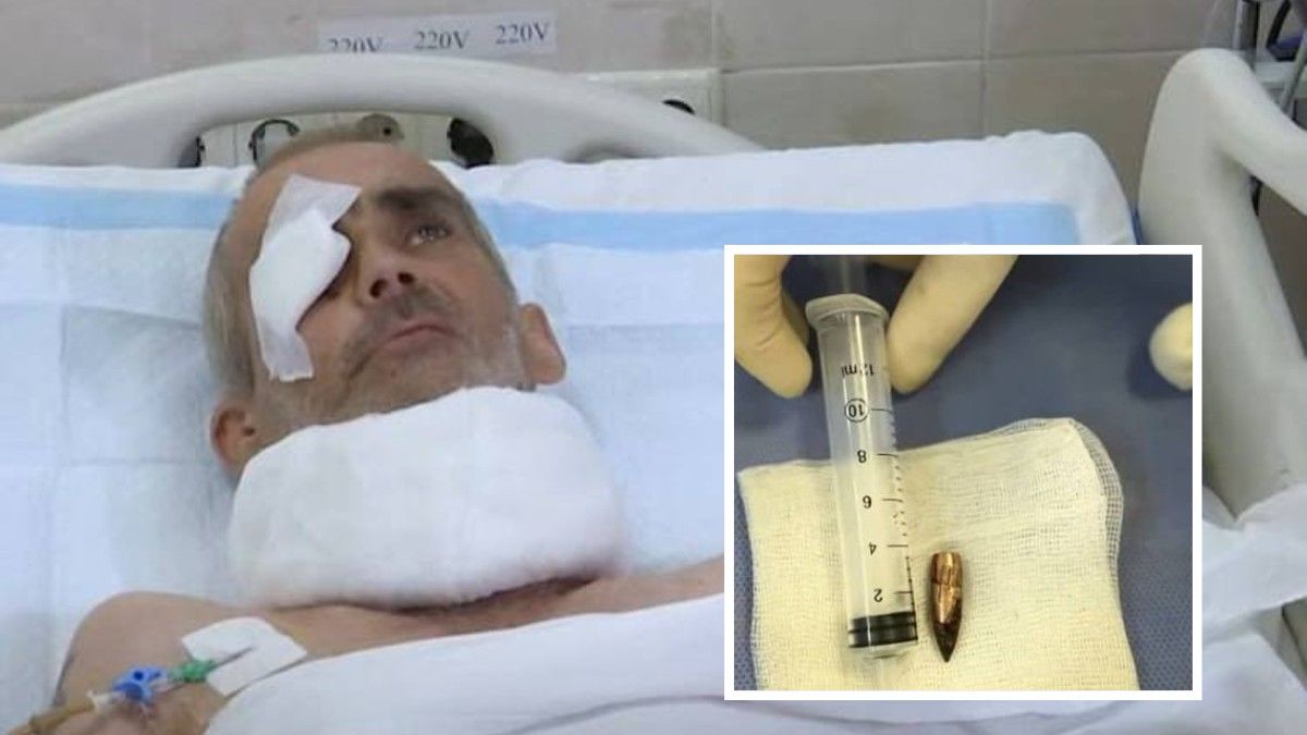 Провели унікальну операцію: у Дніпрі лікарі врятували воїна, через голову якого пройшла куля