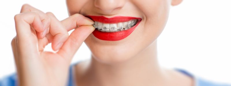 Сколько стоит поставить брекеты: сравниваем виды и цены