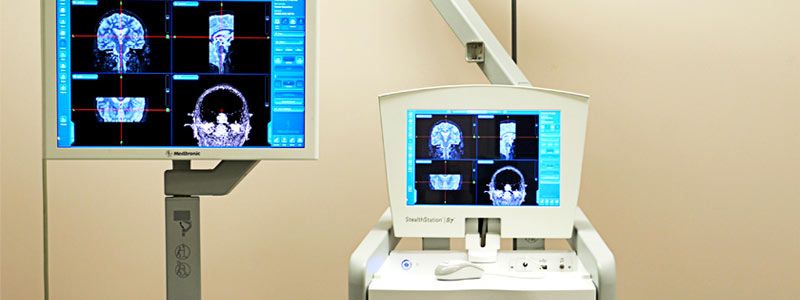 Лечение опухоли головного мозга в Израиле