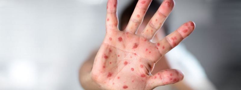 Украина стала лидером в мире по заболеваемости корью