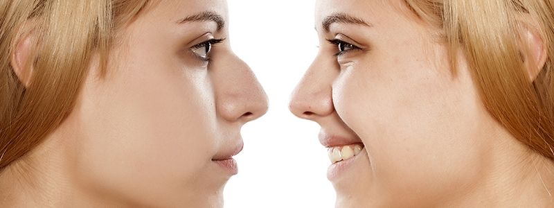 Где в Киеве сделать идеальный нос и почему не нужно бояться ринопластики