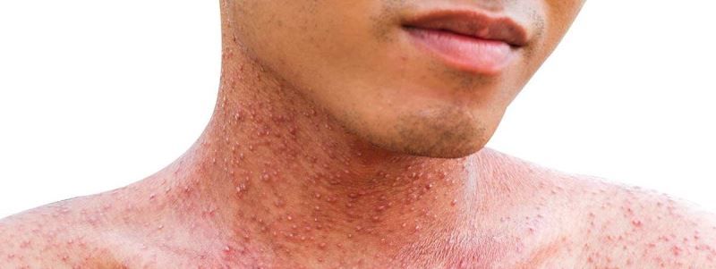 Україну штурмує спалах корі: що робити та як захиститися від вірусу