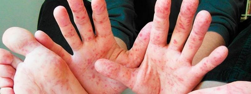 Сколько жителей Украины умерли от кори с начала года