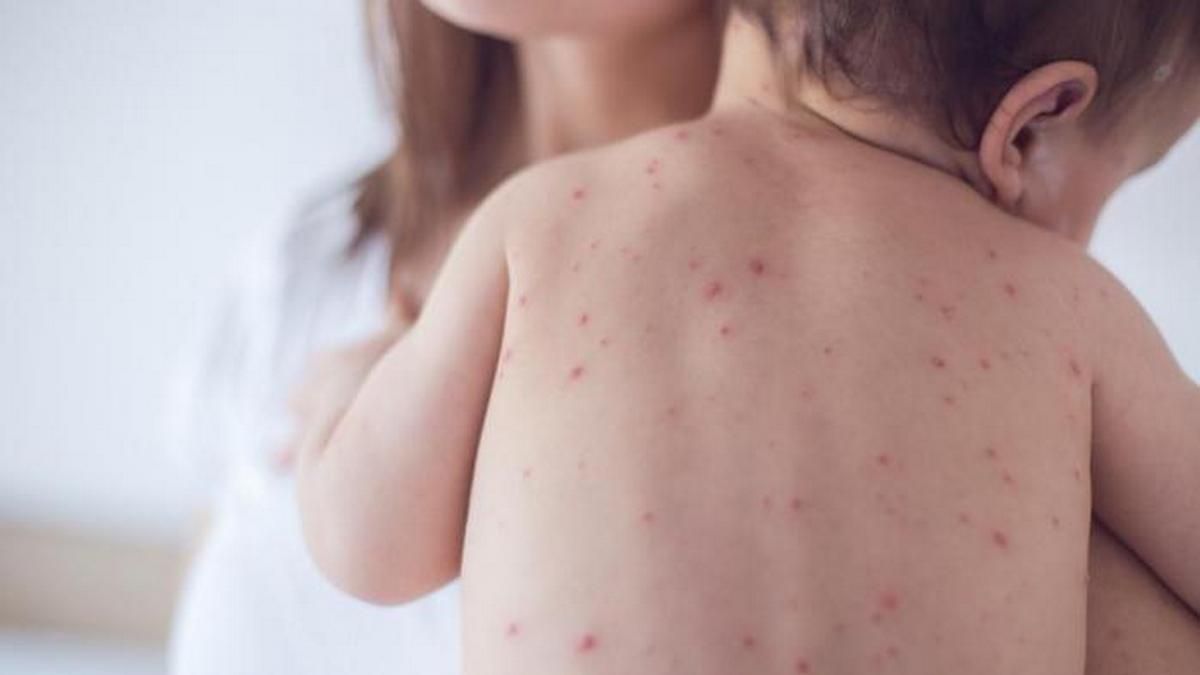 Корь в Украине: сколько людей умерли за время эпидемии