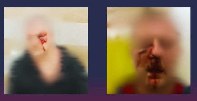 Останній напад закінчився значними травмами