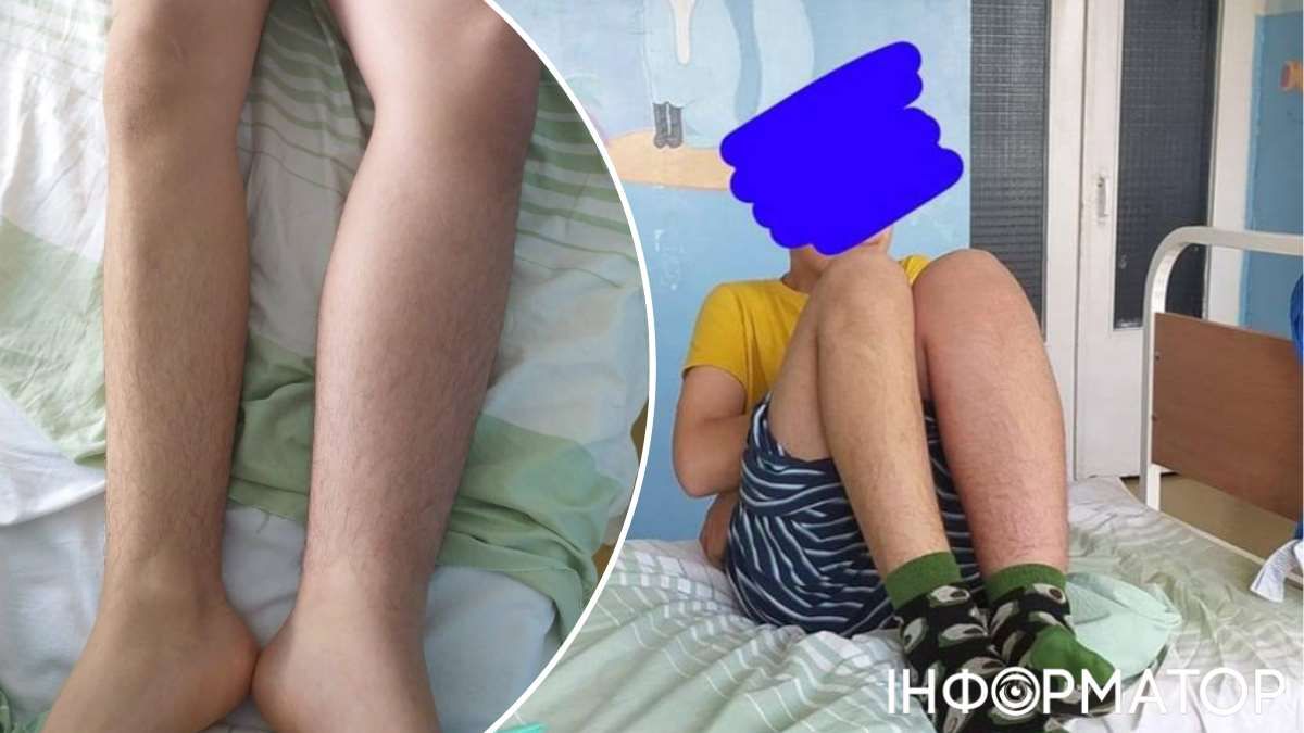 Мати стверджує, що про бійку дізналася випадково - помітила, що в сина збільшилася в розмірах нога