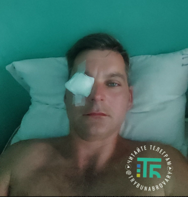 Пострадавший водолаз Андрей Тананай, у мужчины – тяжелая контузия глаза.