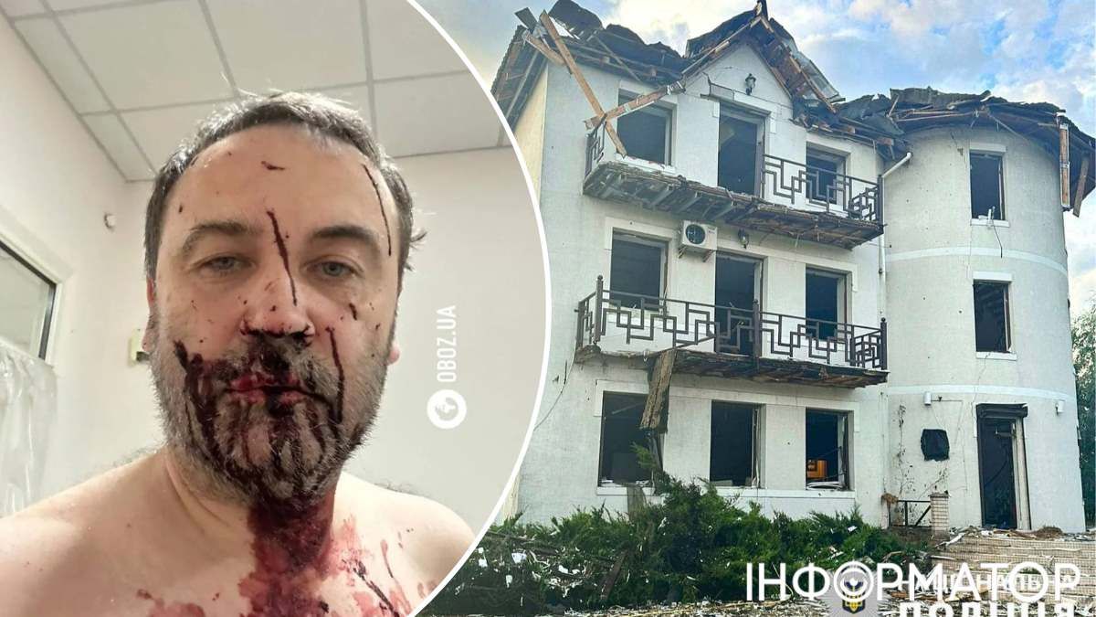 Пономарьов поділився світлиною після "прильоту": має глибокі порізи на обличчі. Фото: Oboz.ua