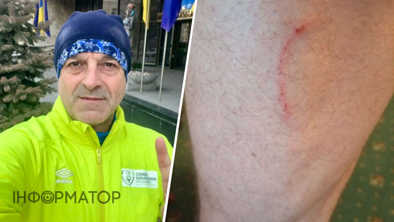 Нардеп Георгій Мазурашу після нападу собаки в парку