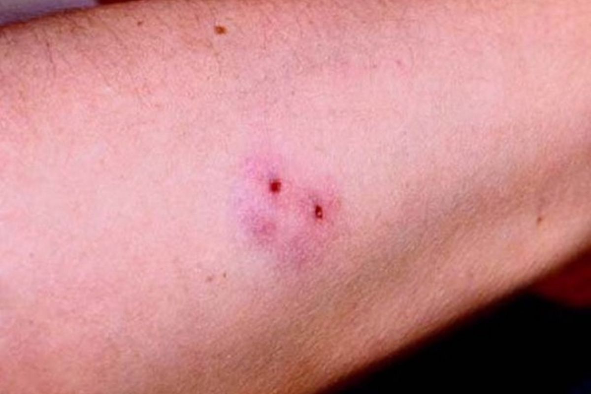 Як розрізнити укуси та що робити після? 1