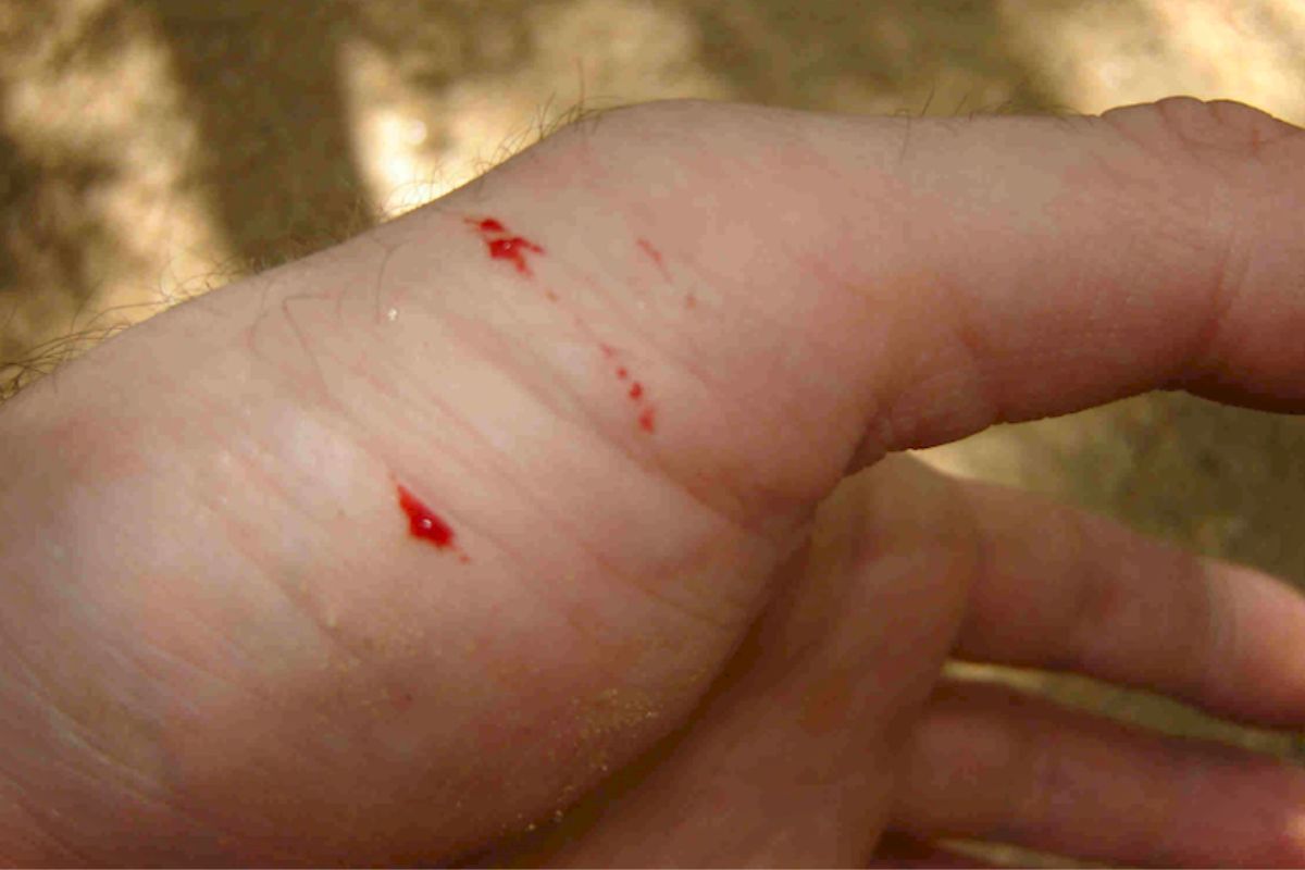 Як розрізнити укуси та що робити після? 2