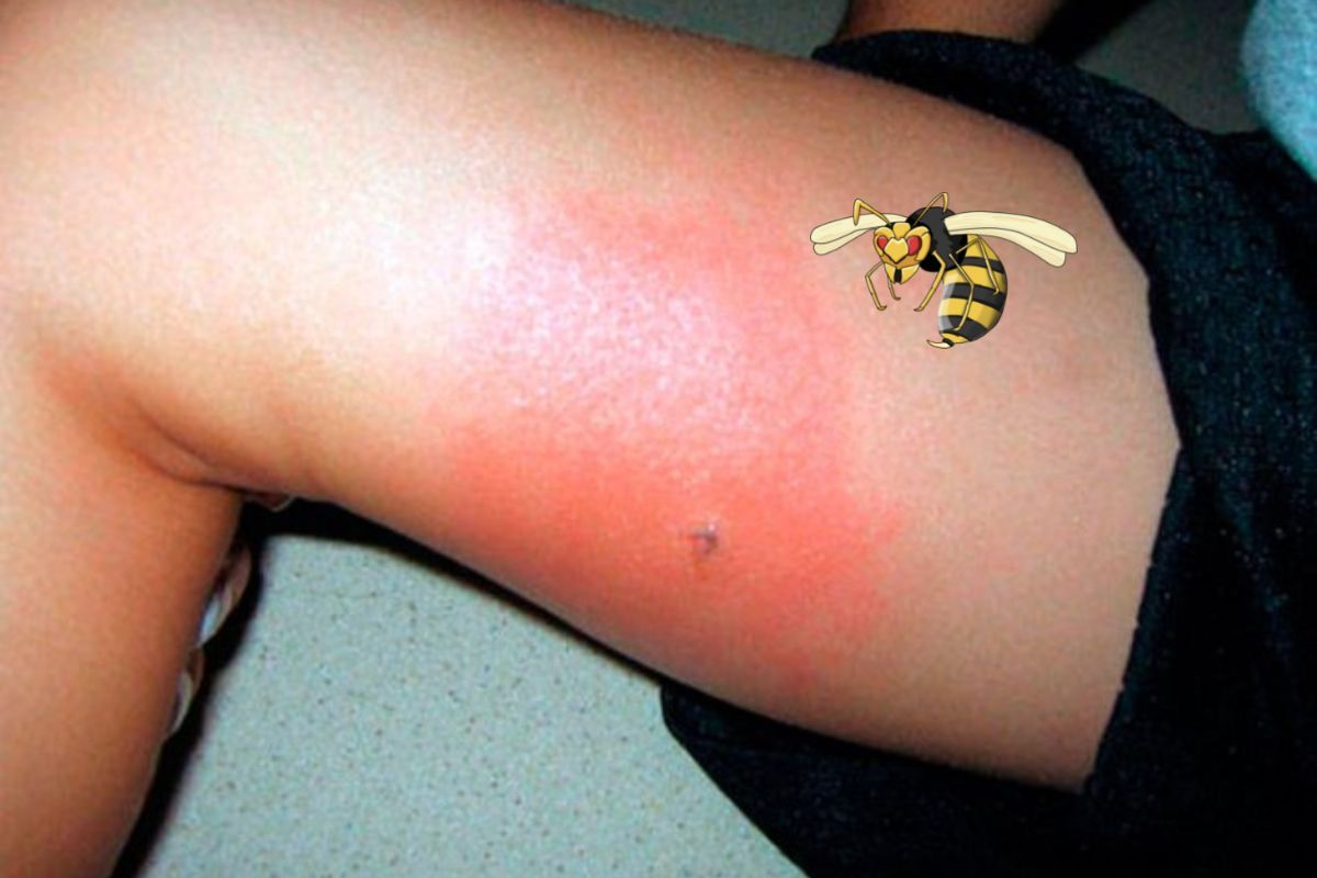 Укус шершня