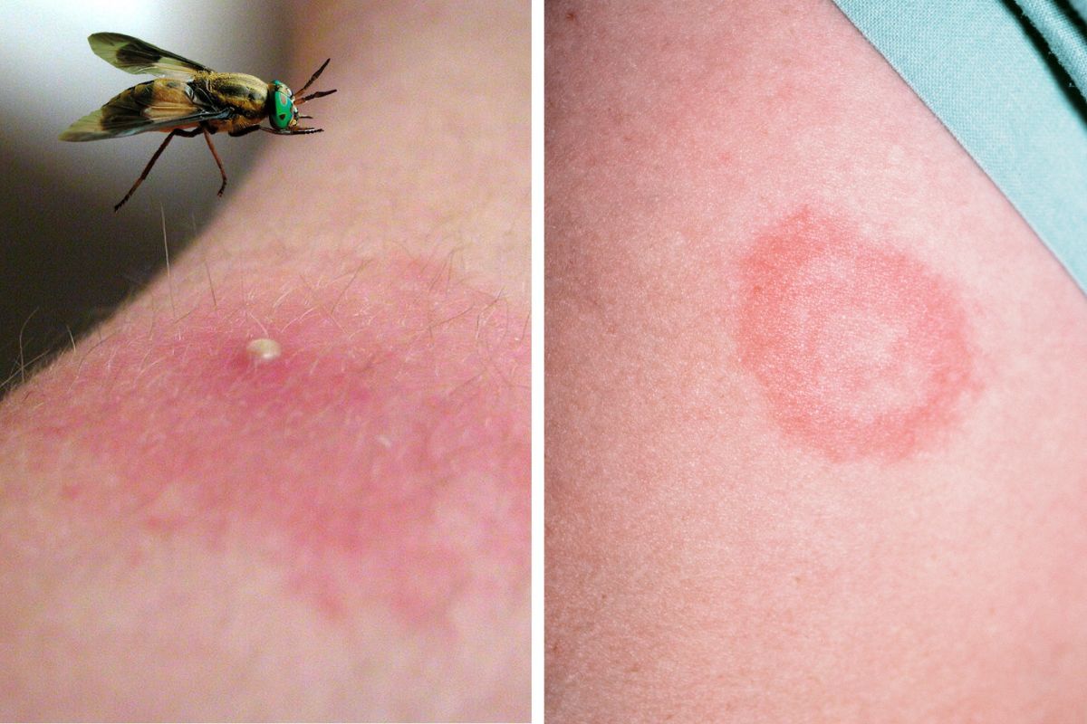 Укус ґедзя та овода