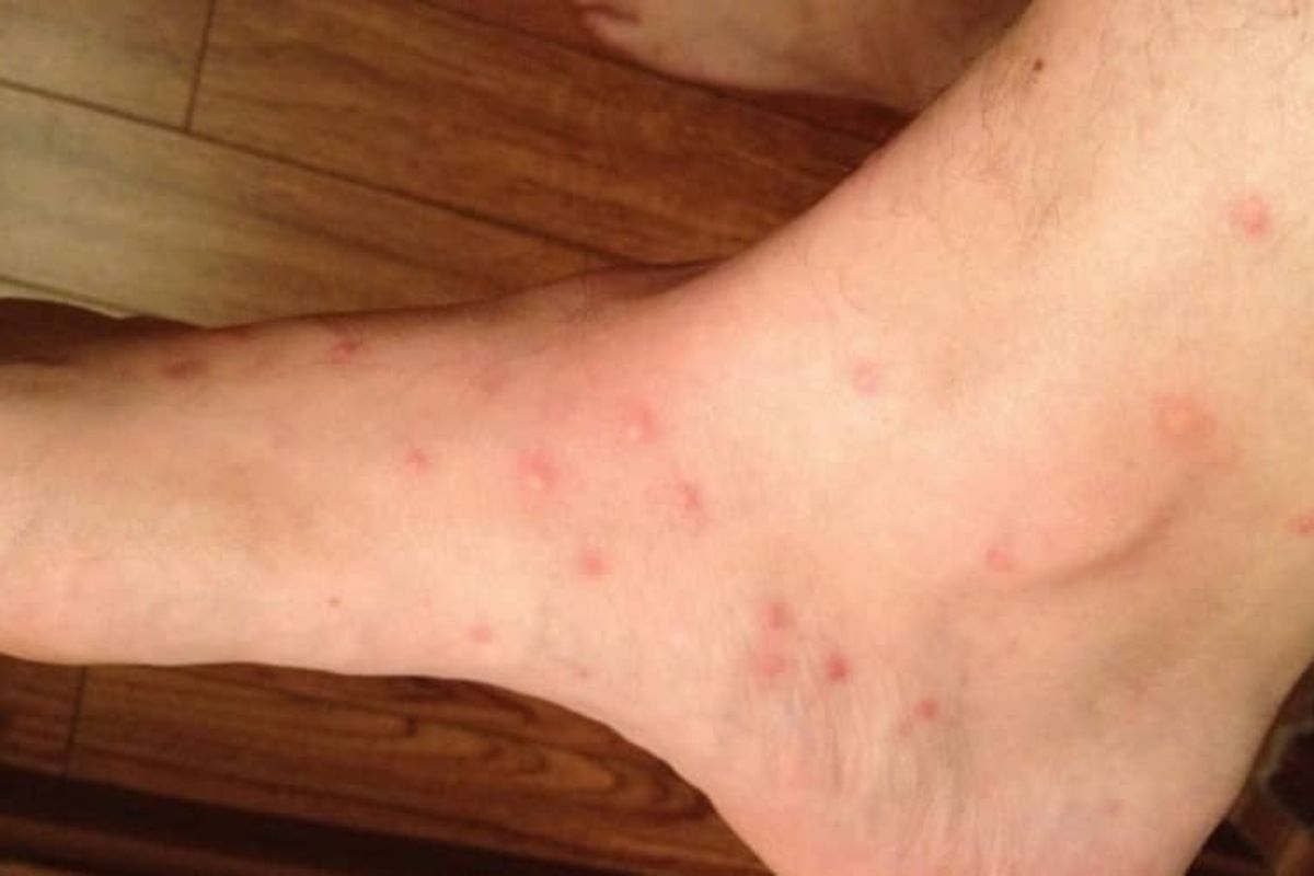 Як розрізнити укуси та що робити після? 6